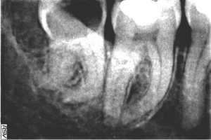 fronimitis